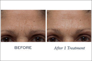 Biotec BAs 840x840Firm a Lift After 1 Treatment Forehead 2